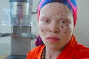 Children with Albinism at High Risk of Abuse & Attacks for Witchcraft Accusations