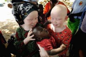 Children with Albinism at High Risk of Abuse & Attacks for Witchcraft Accusations