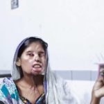Pakistan - Plastic Surgery for Women Who Have Been Burned by Acid or Mutilated
