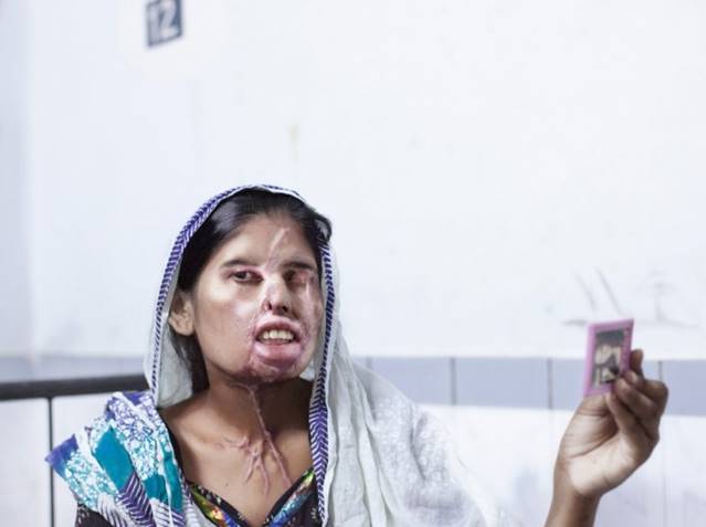 Pakistan - Plastic Surgery for Women Who Have Been Burned by Acid or Mutilated