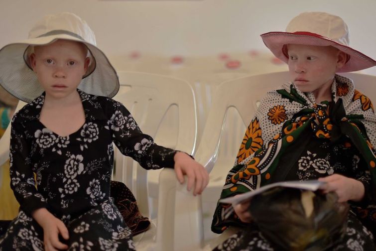 Women & Girls with Albinism Face Multiple Forms of Discrimination